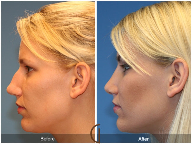 Rhinnoplasty-patient-before-and-after-e1492861724768.jpg